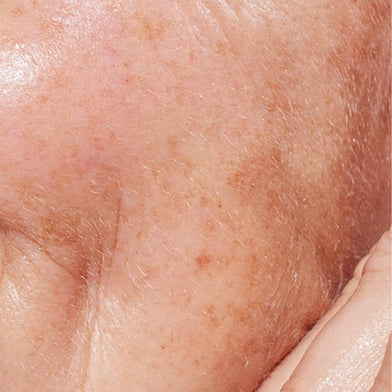 HYPERPIGMENTATION